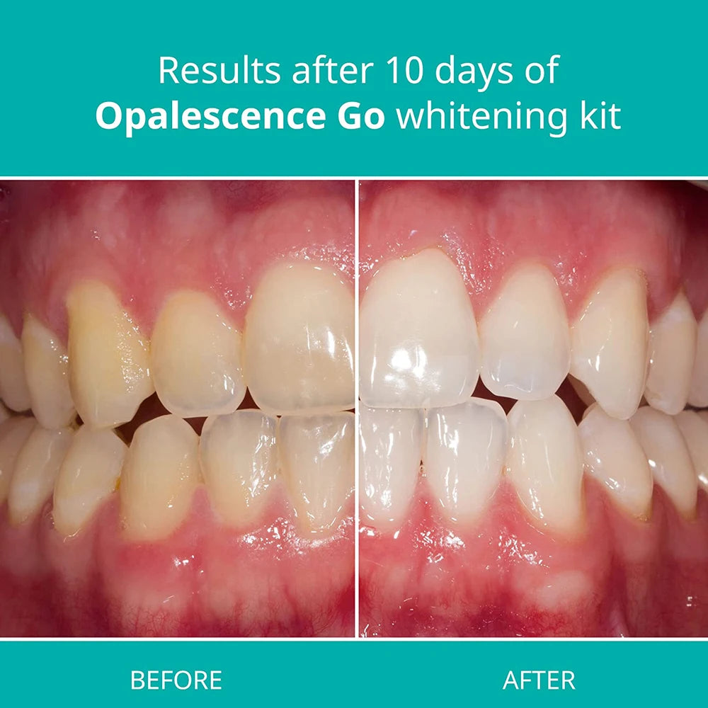 Opalescence Go whitening Trays Prefilled At Home Patient Kit Dental Hydrogen Peroxide Gel PF Mint Ultradent American